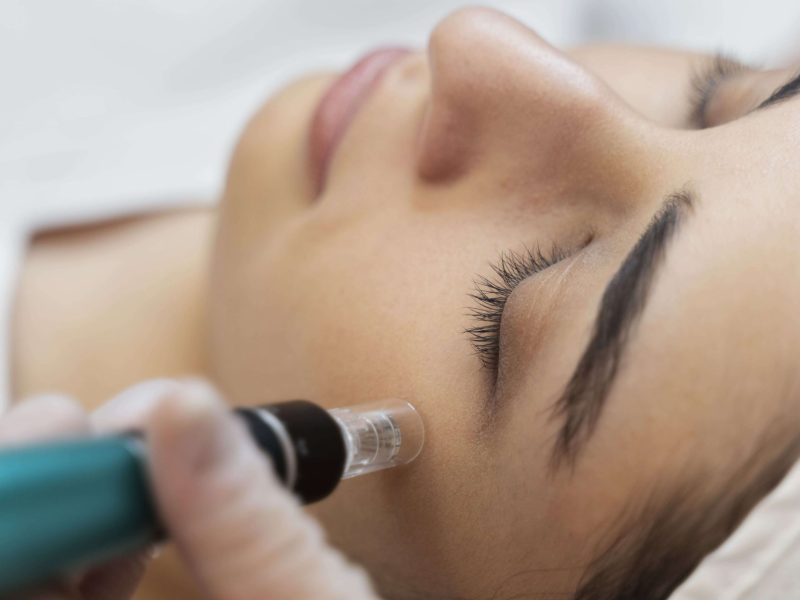 Tratamiento de exfoliación facial con punta de diamante en Albacete para una piel más luminosa y suave.